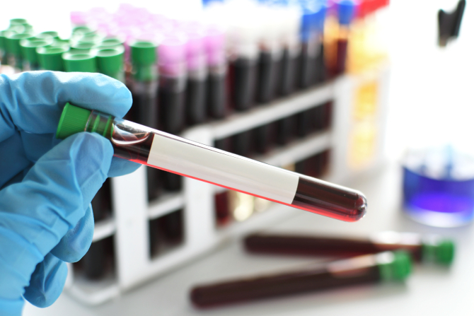 Fotografía de una prueba de sangre para ingreso laboral