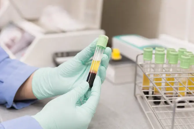 Manos con guantes sosteniendo tubo de sangre con suero para análisis en laboratorio clínico.